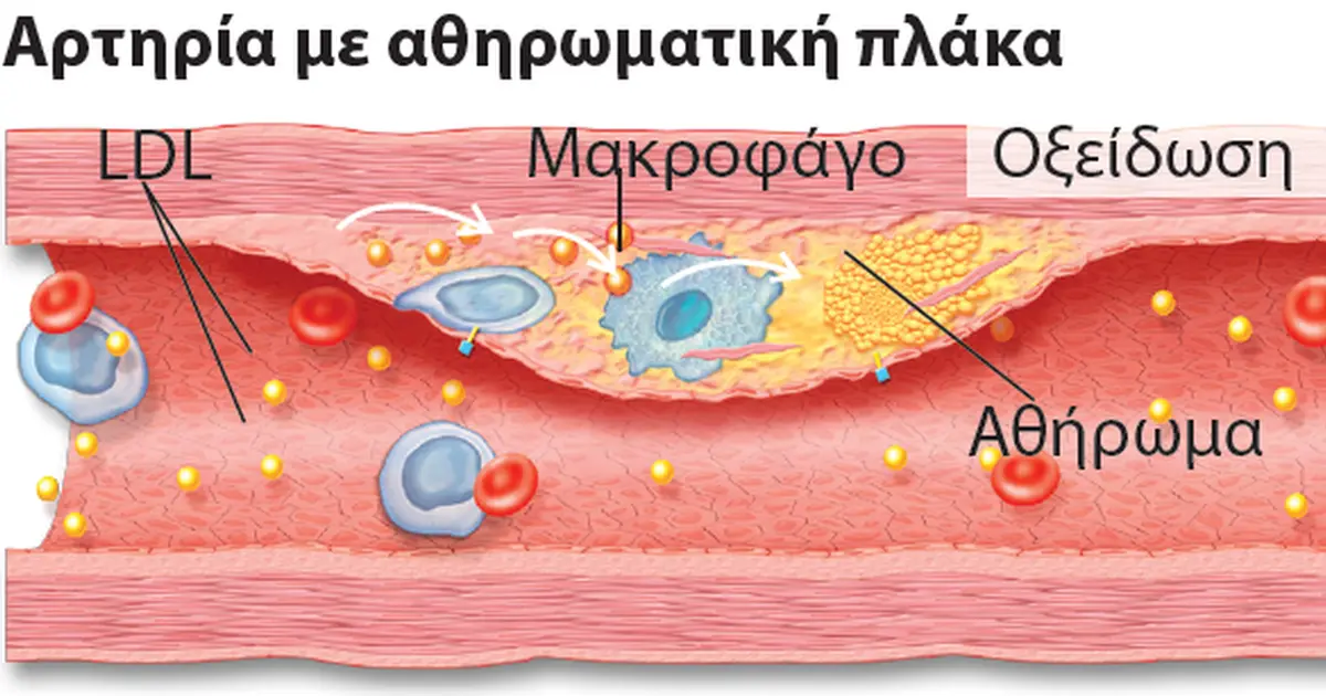 Αρτηρία με αθηρωματική πλάκα