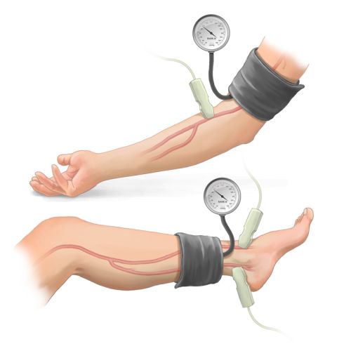 Ο σφυροβραχιόνιος δείκτης