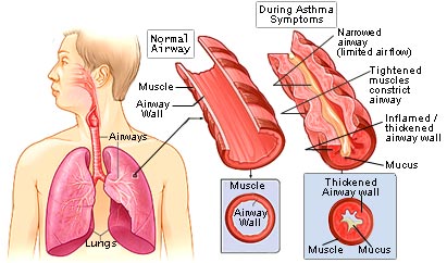 asthma