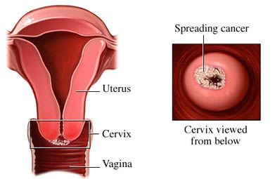 Καρκίνος του τραχήλου της μήτρας