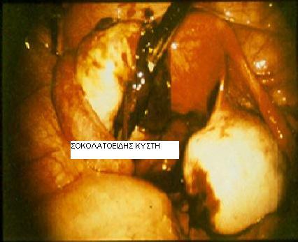 Σοκολατοειδής κύστη