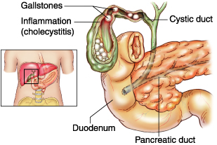 Χολολιθίαση
