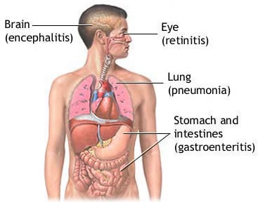 Επιπλοκές του κυτταρομεγαλοϊού σε ανοσοκατασταλμένα άτομα