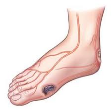 Το διαβητικό πόδι