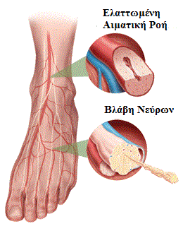 Διαβητικό πόδι