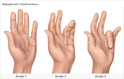 Νόσος Dupuytren