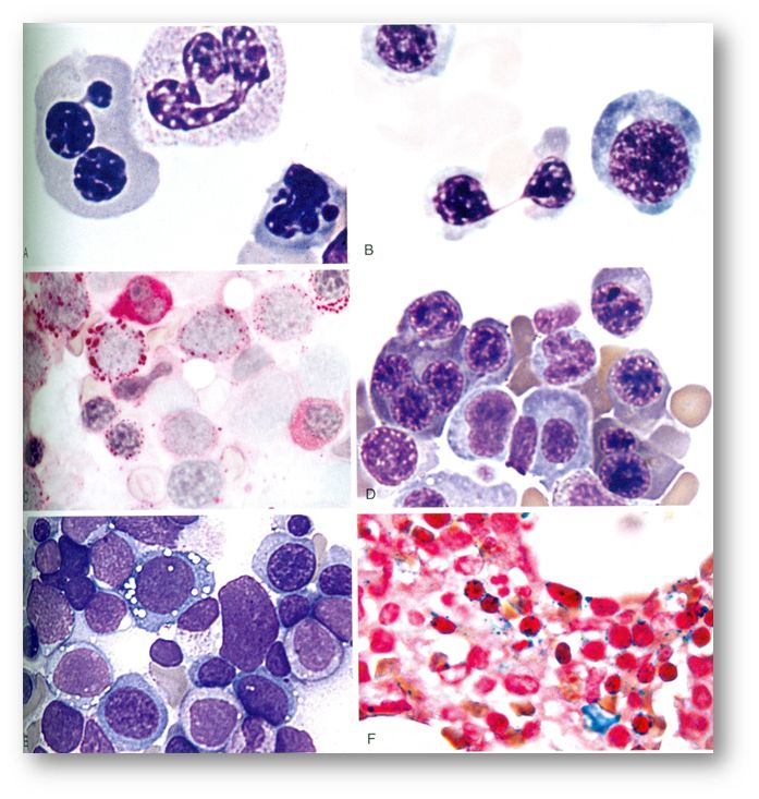 Δυσπλασία ερυθράς σειράς σε επιχρίσματα μυελού