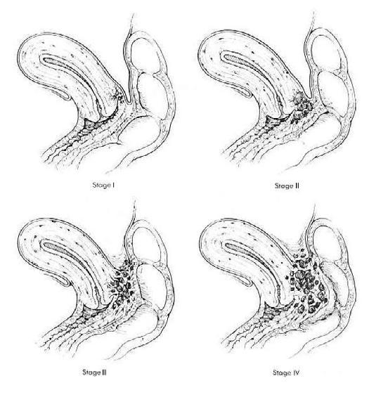 Στάδια ενδομητρίωσης