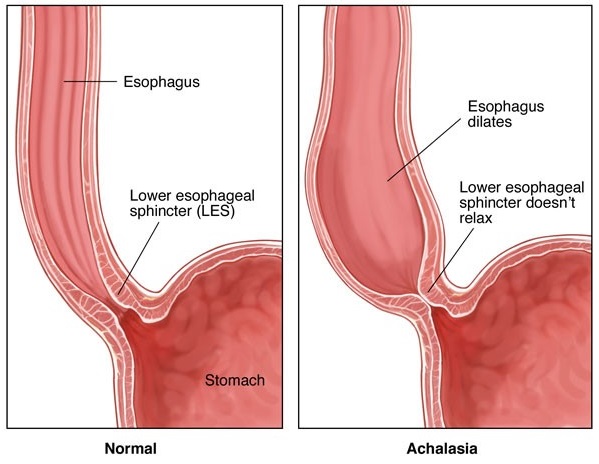 Αχαλασία οισοφάγου