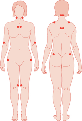 Επώδυνα σημεία (tender points) ινομυαλγίας