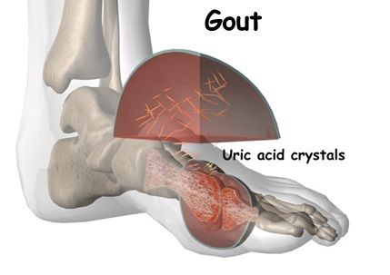 Ουρική αρθρίτιδα