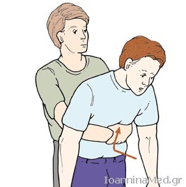 Χειρολαβή του Heimlich