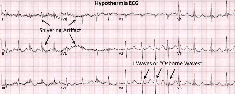 Ηλεκτροκαρδιογράφημα στην υποθερμία