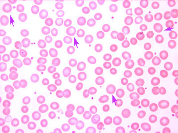 Μακροκυττάρωση