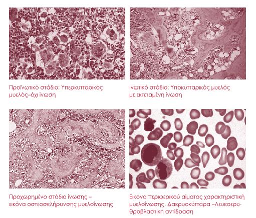 Στάδια μυελοΐνωσης