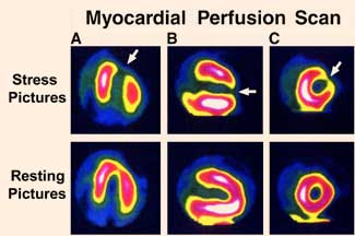 Σπινθηρογράφημα μυοκαρδίου