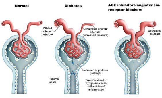 nephron diabetic nephropathy