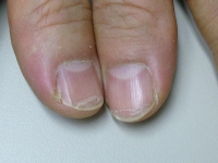 Ονυχόσχαση