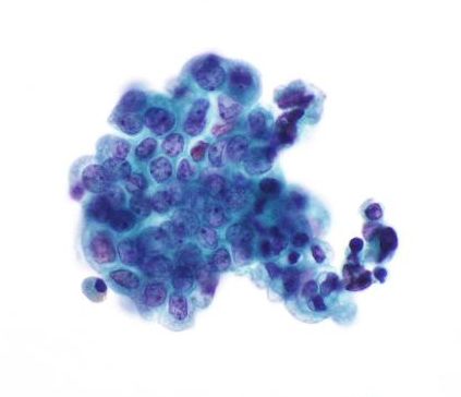 Χαμηλού βαθμού ουροθηλιακό θηλώδες καρκίνωμα στην κυτταρολογική εξέταση ούρων (πηγή: pathologypics.com)