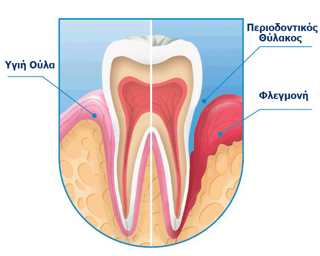 Περιοδοντική νόσος