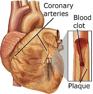 Καρδιαγγειακή νόσος και σακχαρώδης διαβήτης