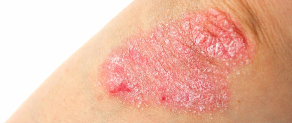 Ψωρίαση