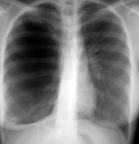 Ακτινολογική εικόνα πνευμοθώρακα