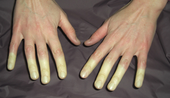Φαινόμενο Raynaud