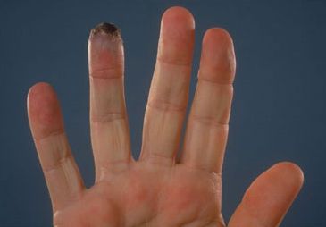 Γάγγραινα παράμεσου δακτύλου σε αθενή με σκληρόδερμα