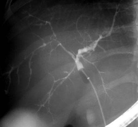 Xολαγγειοπαγκρεατογραφία σε ασθενή με πρωτοπαθή σκληρυντική χολαγγειίτιδα