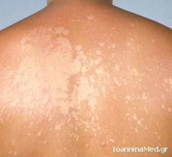 Ποικιλόχρους πιτυρίαση