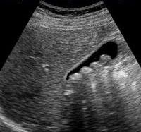 Χολολιθίαση