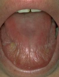 Ξηροστομία